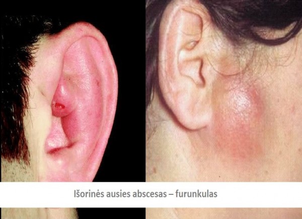 Išorinės ausies abscesas - furunkulas