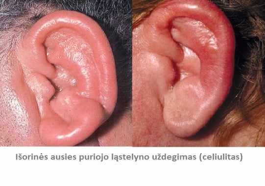 Išorinės ausies uždegimas (celiulitas) 