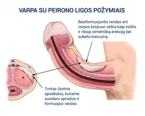 Peirono ligos pozymiai