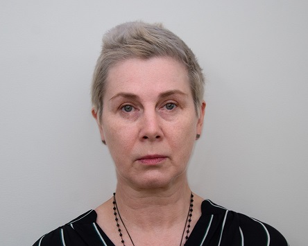 Elena prieš Bionutrilift procedūrą Medicinos diagnostikos ir gydymo centre