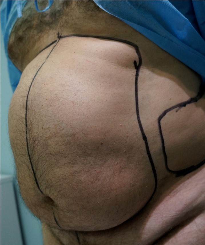 Liposakcija. Riebalų nusiurbimas Medicinos diagnostikos ir gydymo centro (V.Grybo g.Vilnius) plastinė-estetinė operacija